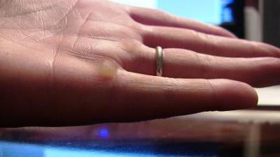 Not a pleasant picuture but that is where you should have a blister if has to have one....